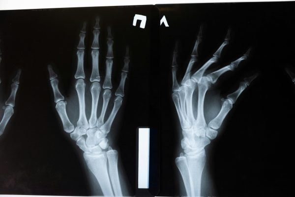 pexels-photo-5723885-5723885 High-resolution x-ray image showing the intricate anatomy of human hands.